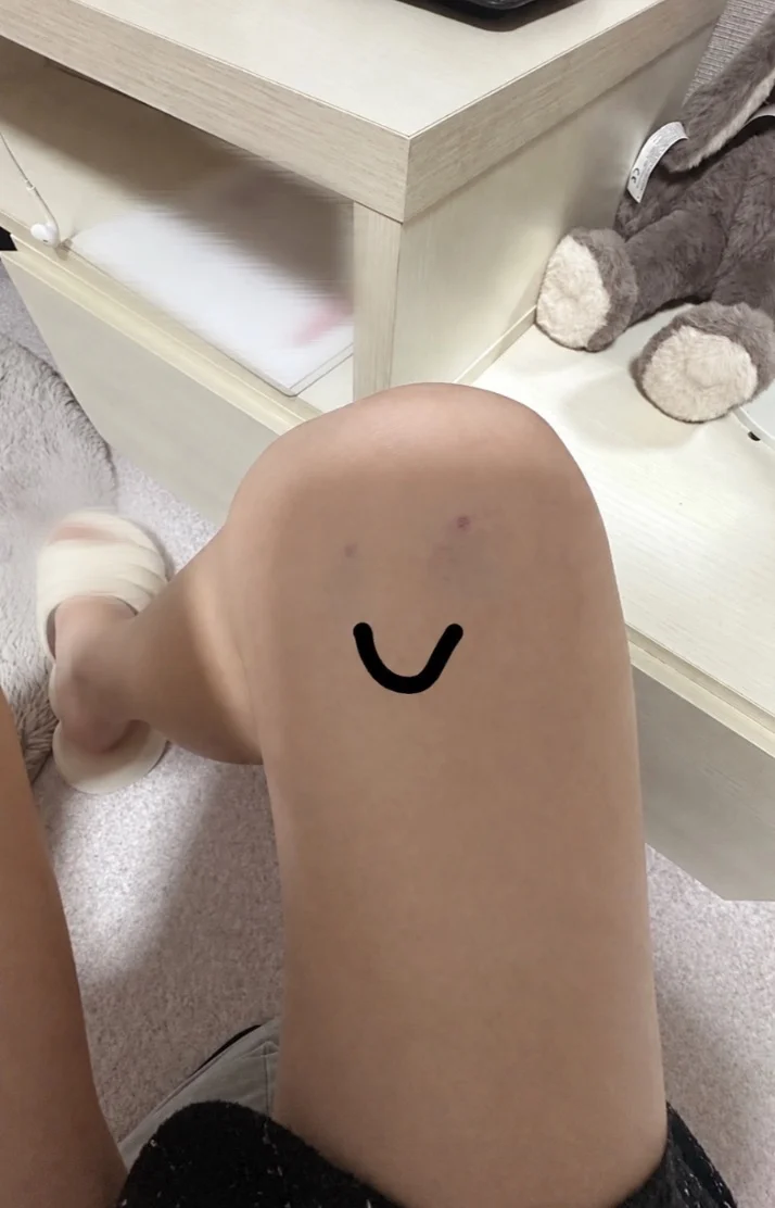 雨音きあらさんの写メ日記：ニコちゃんマークのアザできた🙂